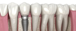 implant