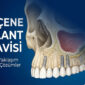 ust cene implant 85x85